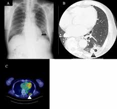 This may reveal an obvious mass, the widening of. Abnormal Shadow On Chest Radiograph Medpage Today
