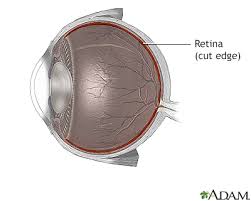 Image result for Retinal Detachment