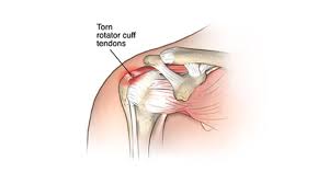 Image result for Rotator Cuff Injury