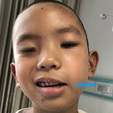 PDF) Analysis of a Case of Facial Nerve Injury Caused by Bee Sting in a  Child
