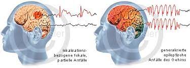 Personen kan svare på tiltale underveis i anfallet, og etterpå husker han. Epilepsie Na Und Anfallsarten