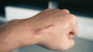 Jump to navigation jump to search. Keloid Na Piercingu Kako I Zasto Nastaje Kreni Zdravo