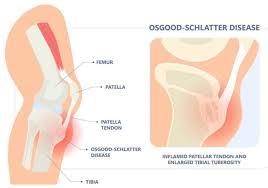 Image result for Pediatric Limp