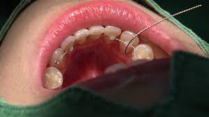 Bonded Lingual Fixed Retainer In 10 Min Youtube