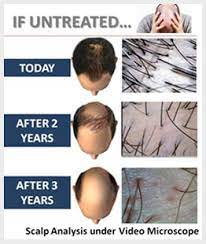 Dr batra's clinic has a range of highly specialized nobel prize winning technologies, such as gro hair treatment and other hair loss treatment lined up to help you with your hair fall problems. Hair Fall Treatment To Control Your Hair Loss Regrowth Of Hair