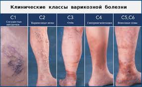 Varikoz Ven Na Nogah Prichiny Simptomy I Lechenie V State Flebologa Gustelyov Yu A