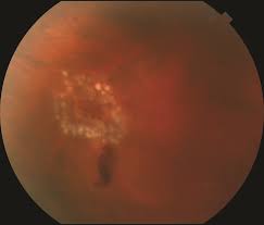 The eye is composed of many fluids. Retinal Tears The American Society Of Retina Specialists