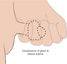 Image result for paraphimosis