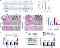 Human Schlafen 5 Regulates Reversible Epithelial And Mesenchymal Transitions In Breast Cancer By Suppression Of Zeb1 Transcription British Journal Of Cancer