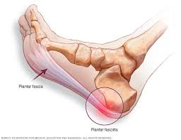 Plantar Fasciitis Symptoms And Causes Mayo Clinic
