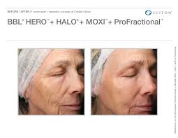 Myth Busters: The Truth About Laser Treatments in Summer