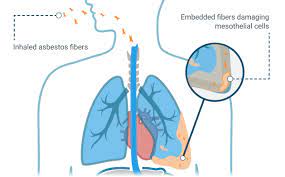Mesothelioma is cancer of the lining that covers most of the body's organs. Mesothelioma What Is Malignant Mesothelioma Cancer
