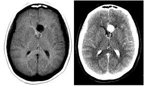 La tomografia assiale computerizzata (abbreviata in tac o tc) è una metodica che utilizza di radiazioni ionizzanti. Aneurisma Aca Diagnostico911 Org