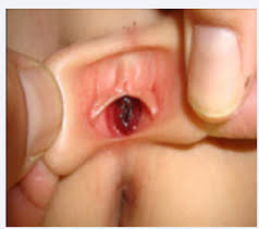 Image result for Urethral Prolapse