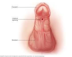 Roughly 90% of cases are the less serious distal hypospadias, in which the urethral opening (the meatus) is on or. Hypospadias Symptoms And Causes Mayo Clinic
