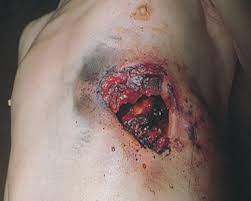 As a rule, 12 gauge wounds, at close range, are more devastating than rifle wounds. What Is It Like To Get Shot In The Chest With A Shotgun From 6 Feet Away Normal Shells Quora