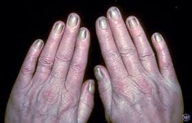 nail changes a dermatologist should examine