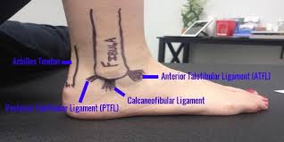 The rehabilitation guidelines for a grade 2 lateral ligament sprain can be split into 4 phases: Sprained Ankle Rock Tape And Compression Band Treatment