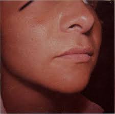 CONTRIBUCION AL TRATAMIENTO DEL VITILIGO Dr. César Lizardo* En mi  experiencia, basada fundamentalmente en el estudio y trata-