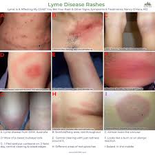 Lyme Disease Rashes Less Than 30 Of People Have A Classic Bullseye Rash Most People Do Not Have A Classic Rash Rashes Can Be Faint Or Almost Purple It Can Be Solid