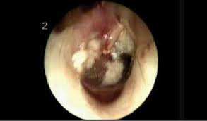 Image result for Myringosclerosis