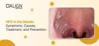 Image result for papillomavirus tongue)