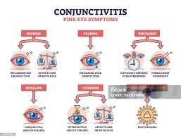 Image result for Allergic Conjunctivitis
