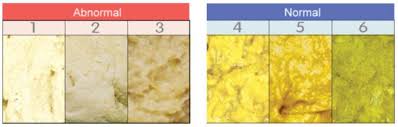 Jaundice In Newborn Babies Sydney Childrens Hospitals Network