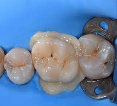 Check out our ceramic restoration selection for the very best in unique or custom, handmade pieces from our there are 388 ceramic restoration for sale on etsy, and they cost $41.33 on average. Which Is The Best Adhesive Cementation Protocol For Glass Ceramic Restoration Dentistry33