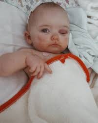 july 2011 ➡️ july 2021 💕 this month marks ten years since Raeca had  surgery to correct sagittal craniosynostosis. at 9 months old the  neurosurgeon went in and reopened her soft spot