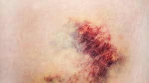 Purpura might look like bruises, but they are not caused by an injury as most regular bruises are. Idiopathic Thrombocytopenic Purpura 6 Signs Of This Rare Disorder Self