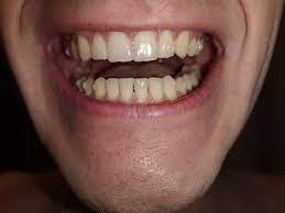 You will also get the solutions of your answers. My Experience Of Invisalign With Gaps Plus My Advice Invisalign