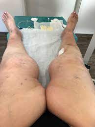 Saphenion Krampfadertherapie Beim Adiposen Update