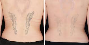 Laser tattoo removal timeline a typical tattoo takes about 10 treatments to remove completely. Tattoo Removal Understanding The Picoway Laser Blush Beverly Hills