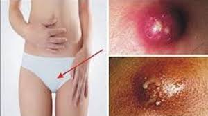 The ingrown public hair can bring about a painful red bump that appears similar to a pimple. Attention Women 5 Kinds Of Vaginal Bumps By Step To Health Youtube