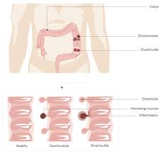 What foods should be avoided with diverticulitis? Diverticular Disease And Diverticulitis Causes Symptoms And Treatment Learning Article Pharmaceutical Journal