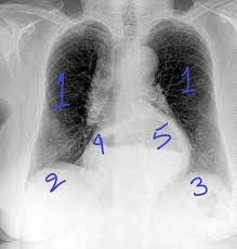 It is used to evaluate the lungs, heart and chest what are the limitations of chest radiography? Deep Learning In Healthcare X Ray Imaging Part 2 Understanding X Ray Images By Arjun Sarkar Towards Data Science
