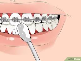 This wire is changed periodically throughout treatment as teeth move to their new positions. How To Fix A Broken Braces Wire 6 Steps With Pictures Wikihow