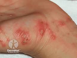 Image result for mite bites on humans