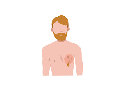 Most breast cancers begin in the ducts breast cancer can spread when the cancer cells get into the blood or lymph system and are carried ductal carcinoma in situ (dcis; Male Breast Cancer Early Signs Navigating Treatment Buoy