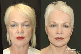 Facelift Before & After Photos in Beverly Hills