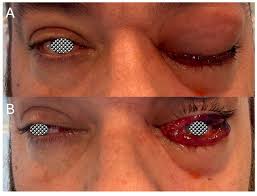 Image result for Sinusitis Prediction Rule