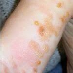 As a noun desquamation is (medical) the shedding of the outer layers of the skin for example, once the rash of measles fades, there is desquamation. Measles Rubeola Morbill Dermatology Advisor