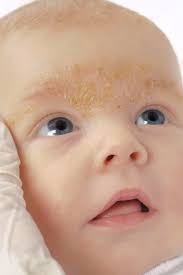 Uv rays, not the temperature, do the. Rash On A Baby S Face Pictures Causes And Treatments