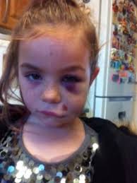 Mum slams primary school after daughter caused 'permanent' damage to her  eye after horror fall from climbing frame