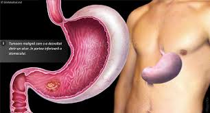 In cadrul testelor facute de specialisti, medicamentul a prelungit cu cateva luni viata. ExplicaÅ£ia DetaliatÄƒ A Cancerului Gastric Cancerul De Stomac Cauzele Simptomele Si Semnele Etapele Stadiile DezvoltÄƒrii PosibilitÄƒÅ£ile De Tratament Pronosticul Sitemedical Ro