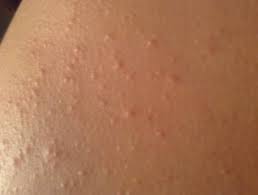 If You Have Little Red Or Black Bumps In Patches On Your Upper Arms Backside Or Thighs That Resemble Chicken Skin Skin Bumps Itchy Red Bumps Itching On Legs