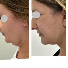 V Neck or Deep Neck lift: Go under muscles platysma and digastric , sub  platysmal fat excision ,submandilular gland excision and muscle tightening  in anterior and retoauricular area . This gives an