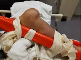 Image result for Knee Dislocation