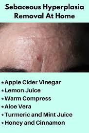 Apple cider vinegar, made from fermented apples, has been used as a health tonic for thousands of years for many different ailments. Sebaceous Hyperplasia Removal At Home How To Remove Fresh Aloe Vera Gel Oil Gland
